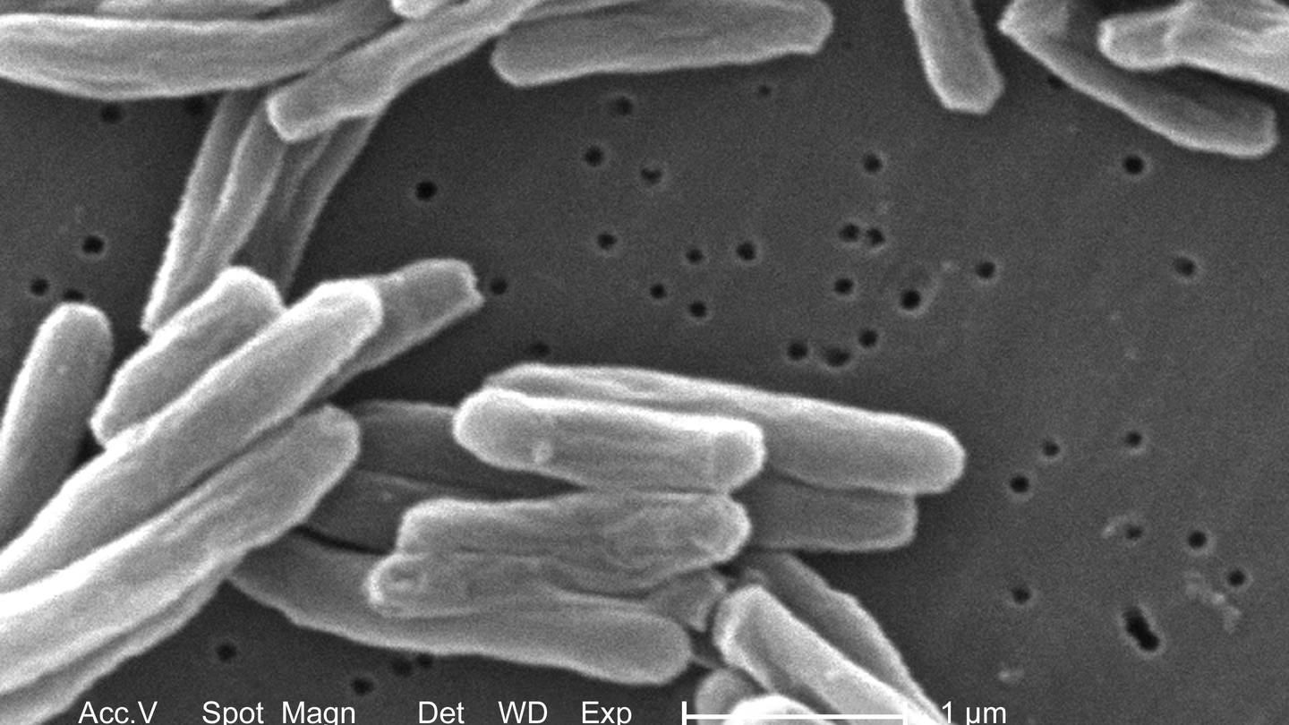 US tuberculosis cases were at the highest level in a decade in 2023  WHIO TV 7 and WHIO Radio [Video]