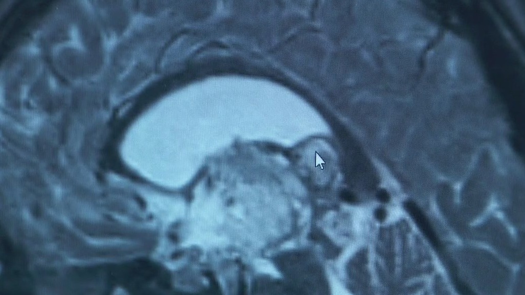 MN teen has brain tumor removed in 12-hour procedure [Video]