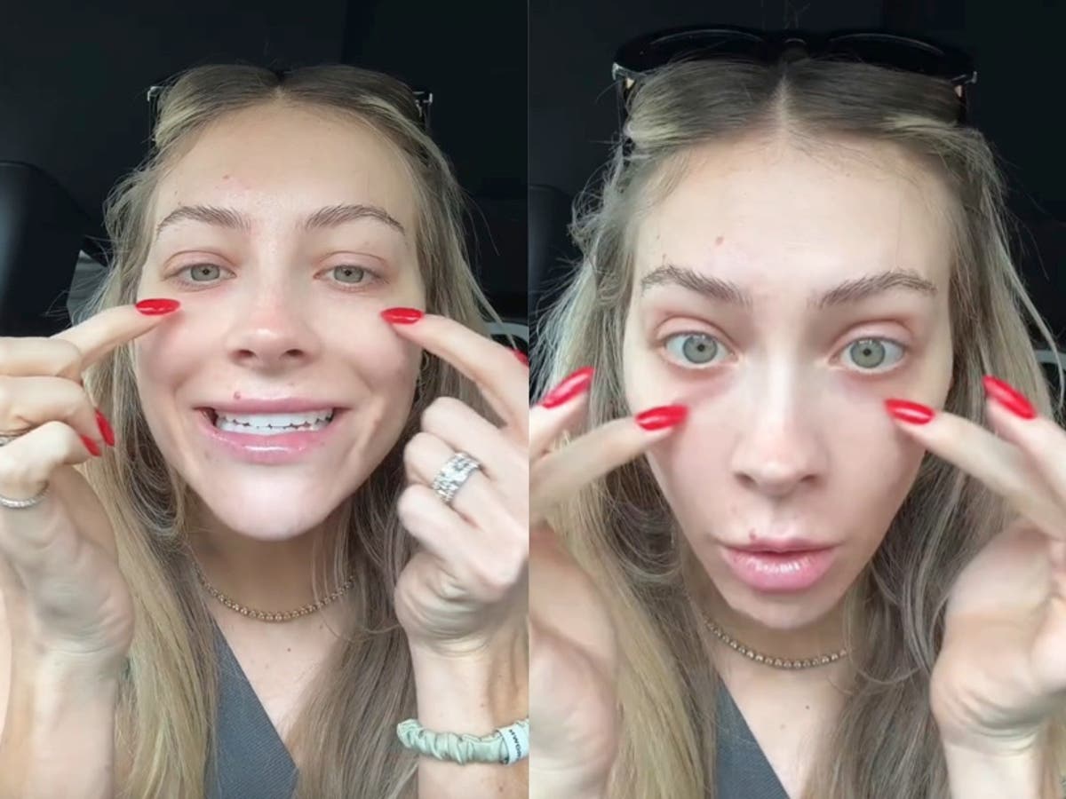 Woman shares why she regrets getting under eye filler [Video]